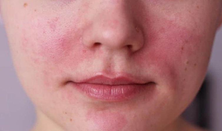 Dau hieu canh bao ung thu gan anh 1