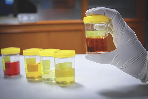 Dau hieu canh bao ung thu gan anh 3