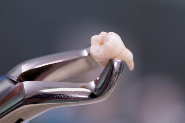 Nguoi phu nu tai Trung Quoc tu vong sau khi nho 20 chiec rang hinh anh