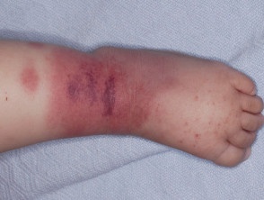 Giai ma can benh lan dau tien ghi nhan o Viet Nam hinh anh