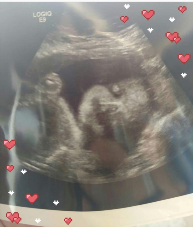 mang thai giả ảnh 3 mang thai gia anh 3