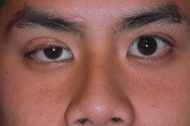 Can benh chet nguoi sau hien tuong sup mi mat hinh anh