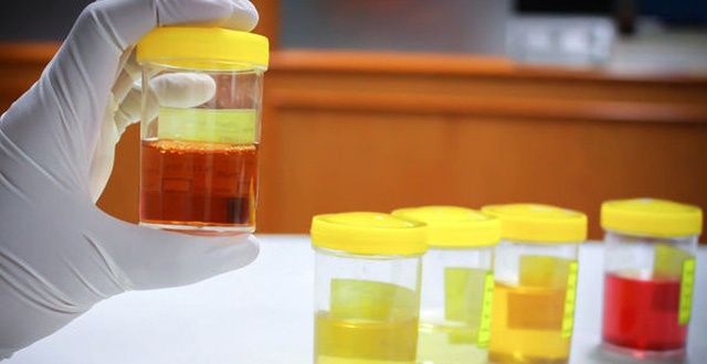 ung thu bang quang anh 1