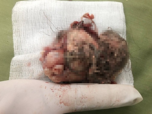 khối u quái ảnh 1 khoi u quai anh 1