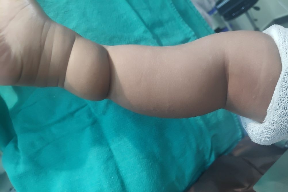 Trieu chung benh o tre co the bi lam tuong la ngan tay chan hinh anh