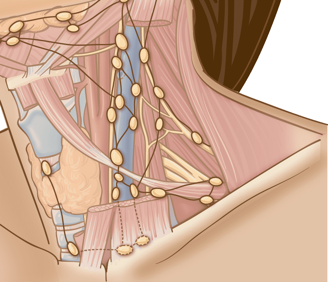 noi hach la dau hieu cua benh ung thu anh 1