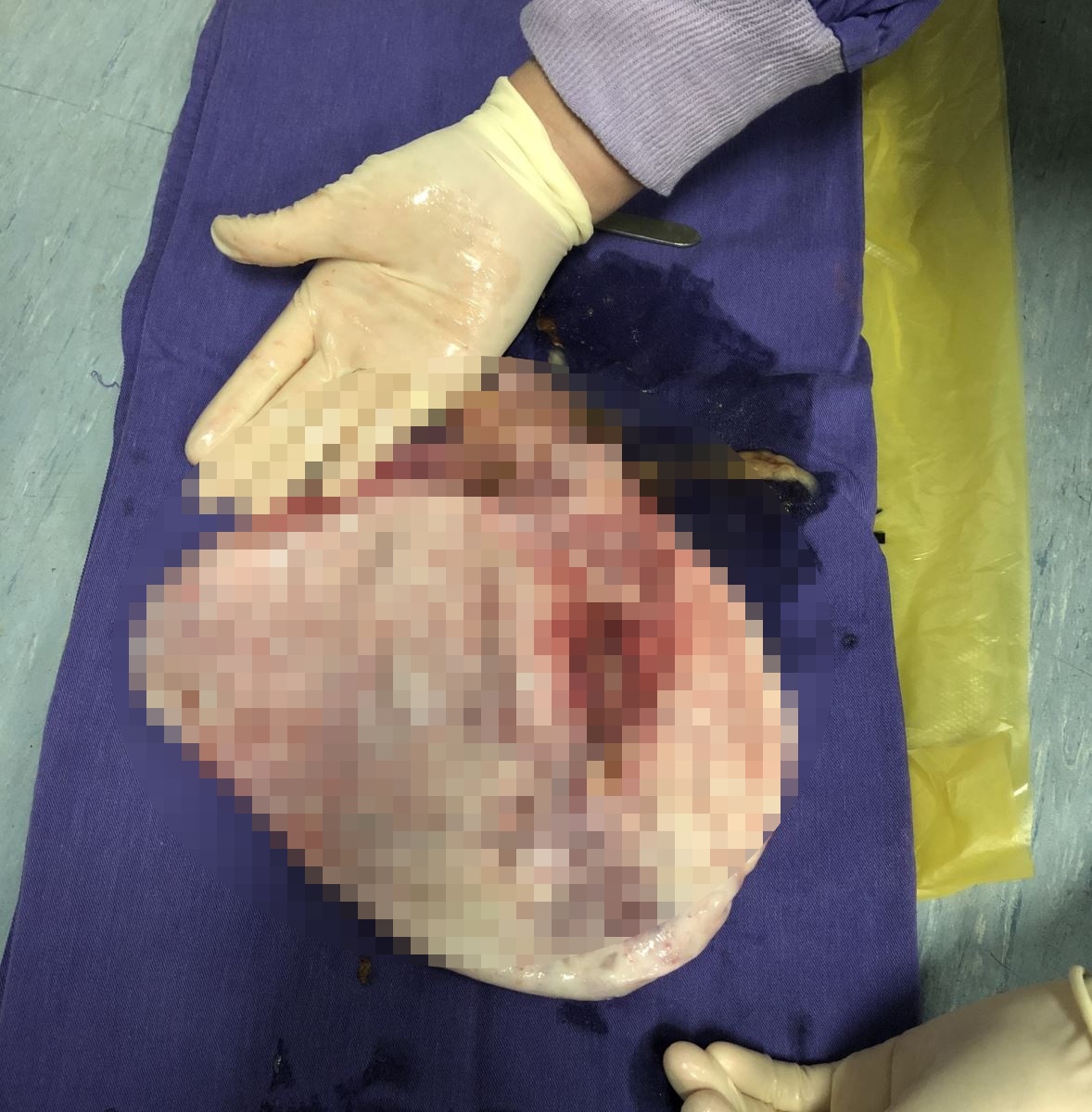 Nhu mang bau 6 thang vi khoi u khong lo anh 1