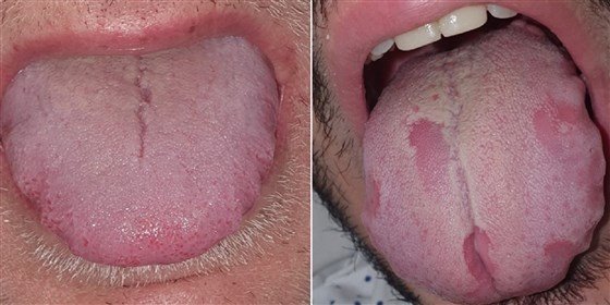 trieu chung la o nguoi mac Covid-19 anh 1