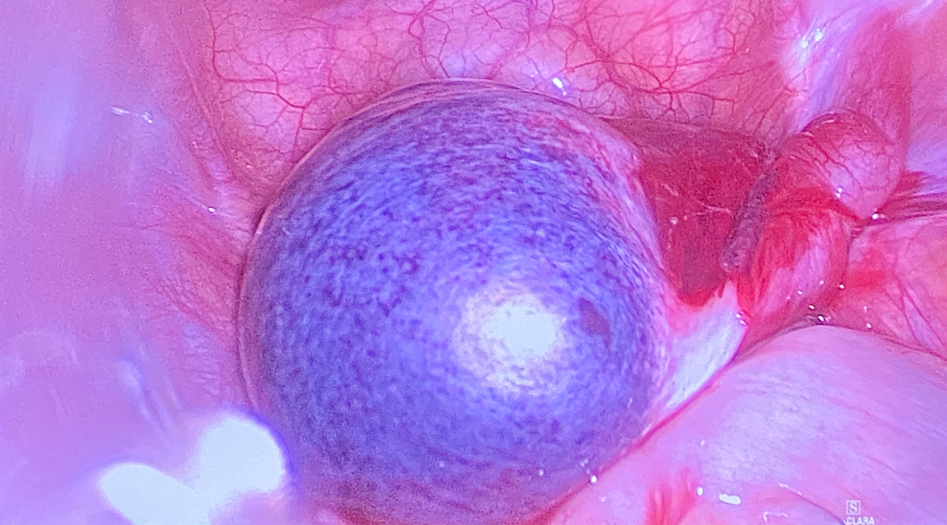 Khoi u chua day rang,  xuong anh 1