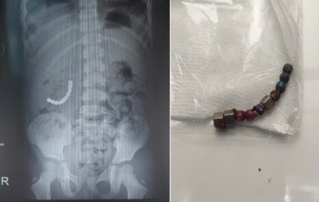 thung ruot vi nuot bi nam cham anh 1