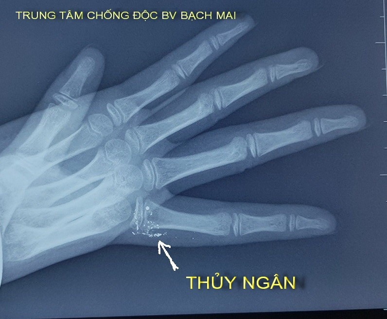nhiem doc thuy ngan anh 1