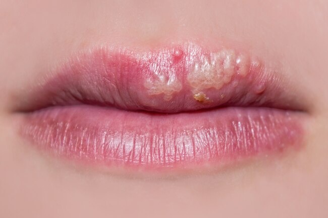 Trieu chung nhiem HIV qua tung giai doan hinh anh