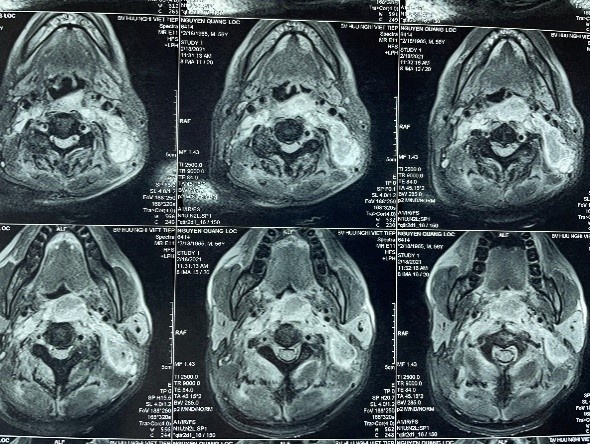 Nhiem trung co anh 1