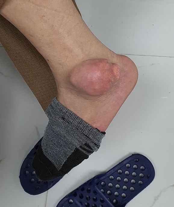 chua gout bang thuoc tren mang anh 1