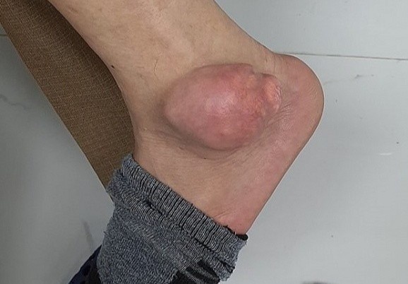 Co chan co khoi u sung to vi chua gout bang thuoc tren mang hinh anh