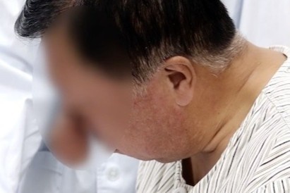 Can benh khien nguoi mac moc mui voi voi sau khi uong ruou hinh anh