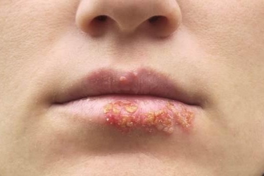 Ty le nguoi mac benh lay truyen qua duong tinh duc tai My cao ky luc hinh anh