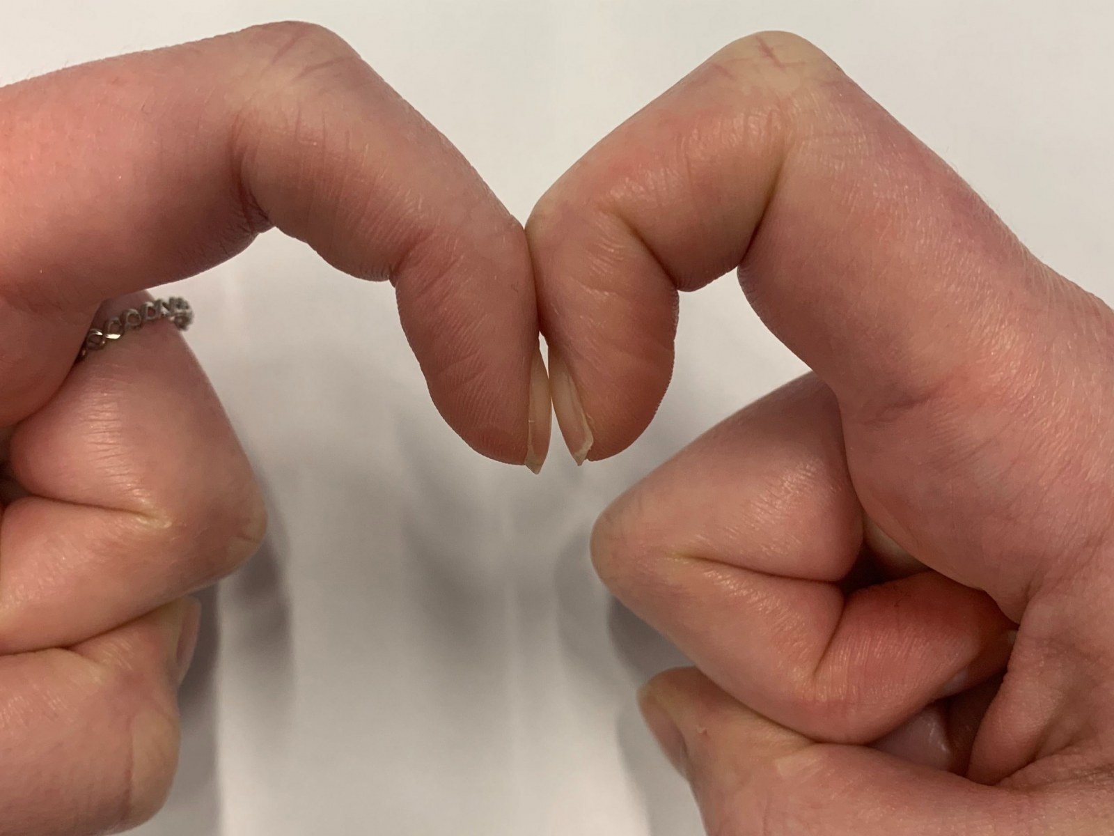 benh ly nguy hiem sau su bien doi cua mong tay anh 1