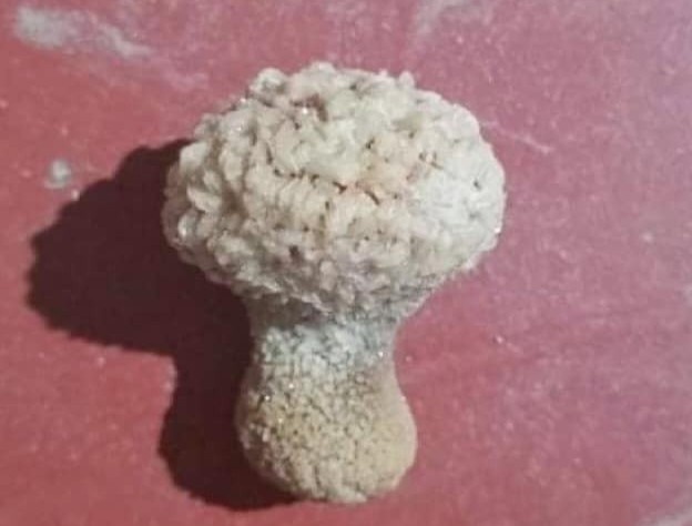 Vien soi hinh nam trong bang quang benh nhan hinh anh