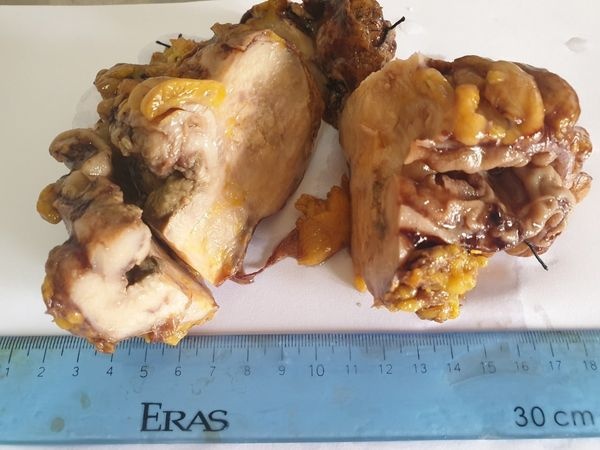 ung thu the hiem gap anh 1