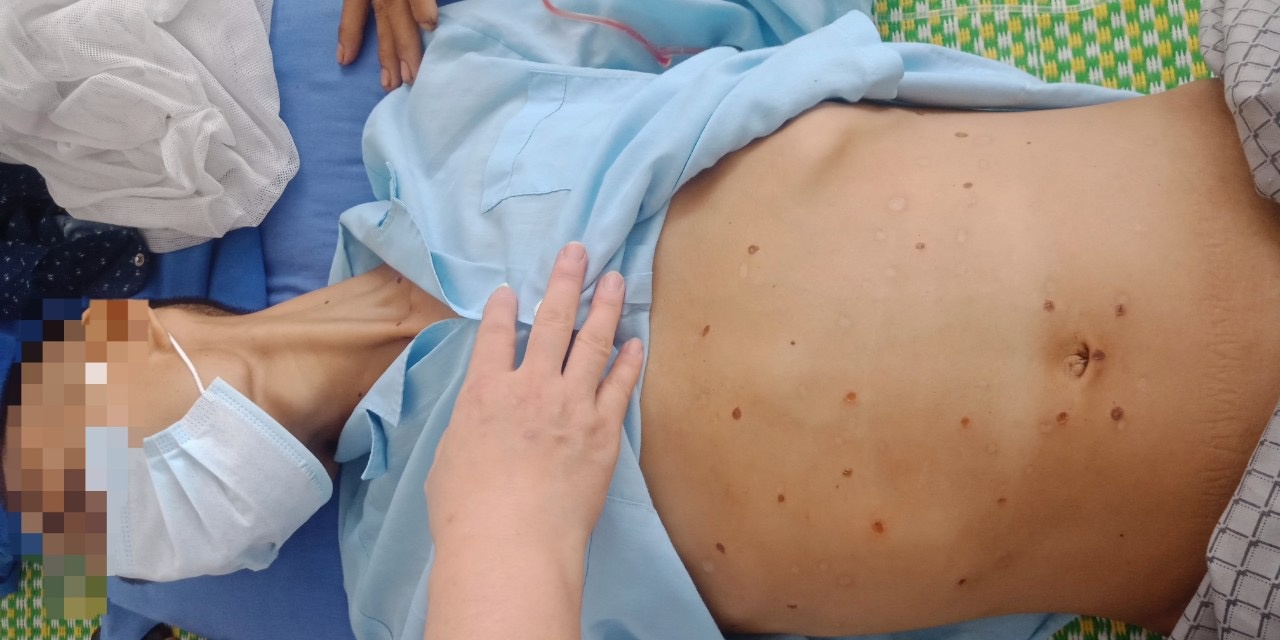 chua xo gan bang cach dan gian anh 1