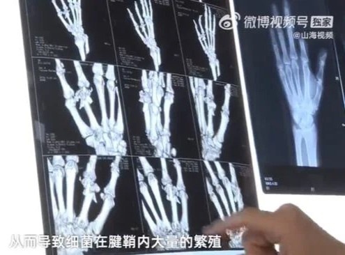 suýt phải cưa tay sau khi bị bút chì đâm ảnh 1 suyt phai cua tay sau khi bi but chi dam anh 1