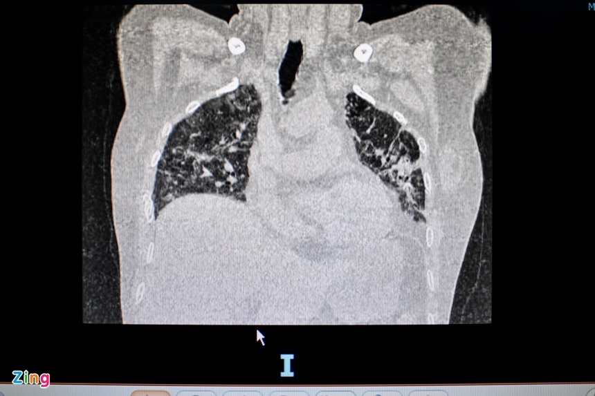 Xo phoi hau Covid-19 anh 2