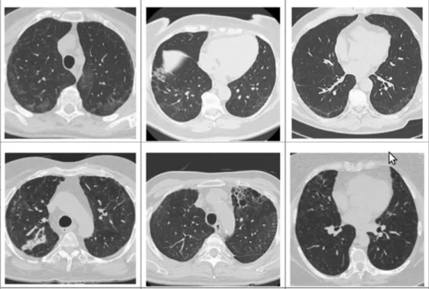 Xo phoi hau Covid-19 anh 1