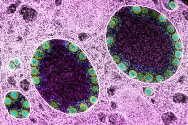 Canh bao hai bien chung nCoV co the gay lan song lay nhiem moi hinh anh