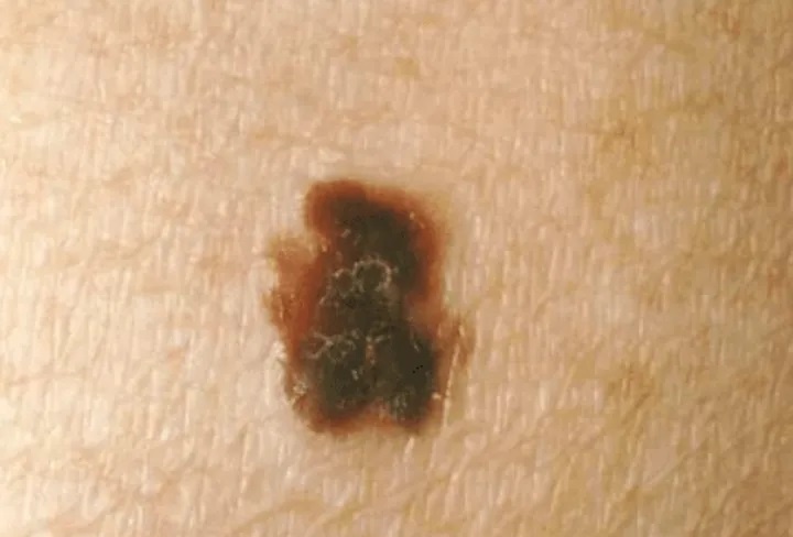 phat hien ung thu qua not ruoi anh 3