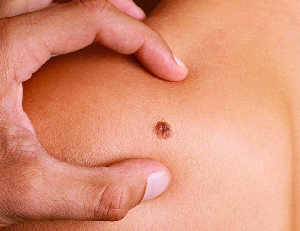 phat hien ung thu qua not ruoi anh 1