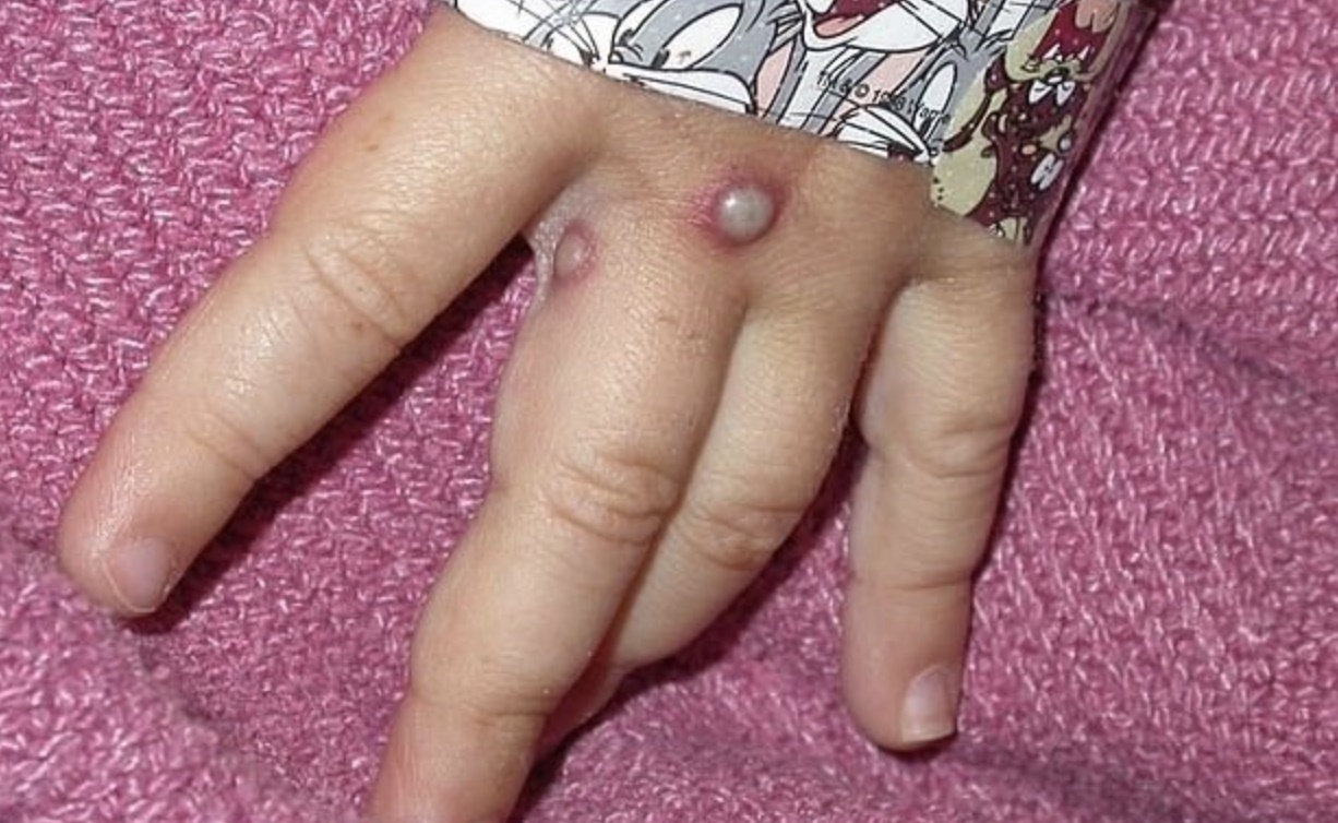 Vi sao benh dau mua khi kho tro thanh dai dich nhu Covid-19? hinh anh