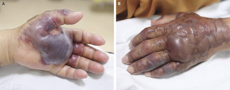 Vi khuan an thit nguoi anh 3