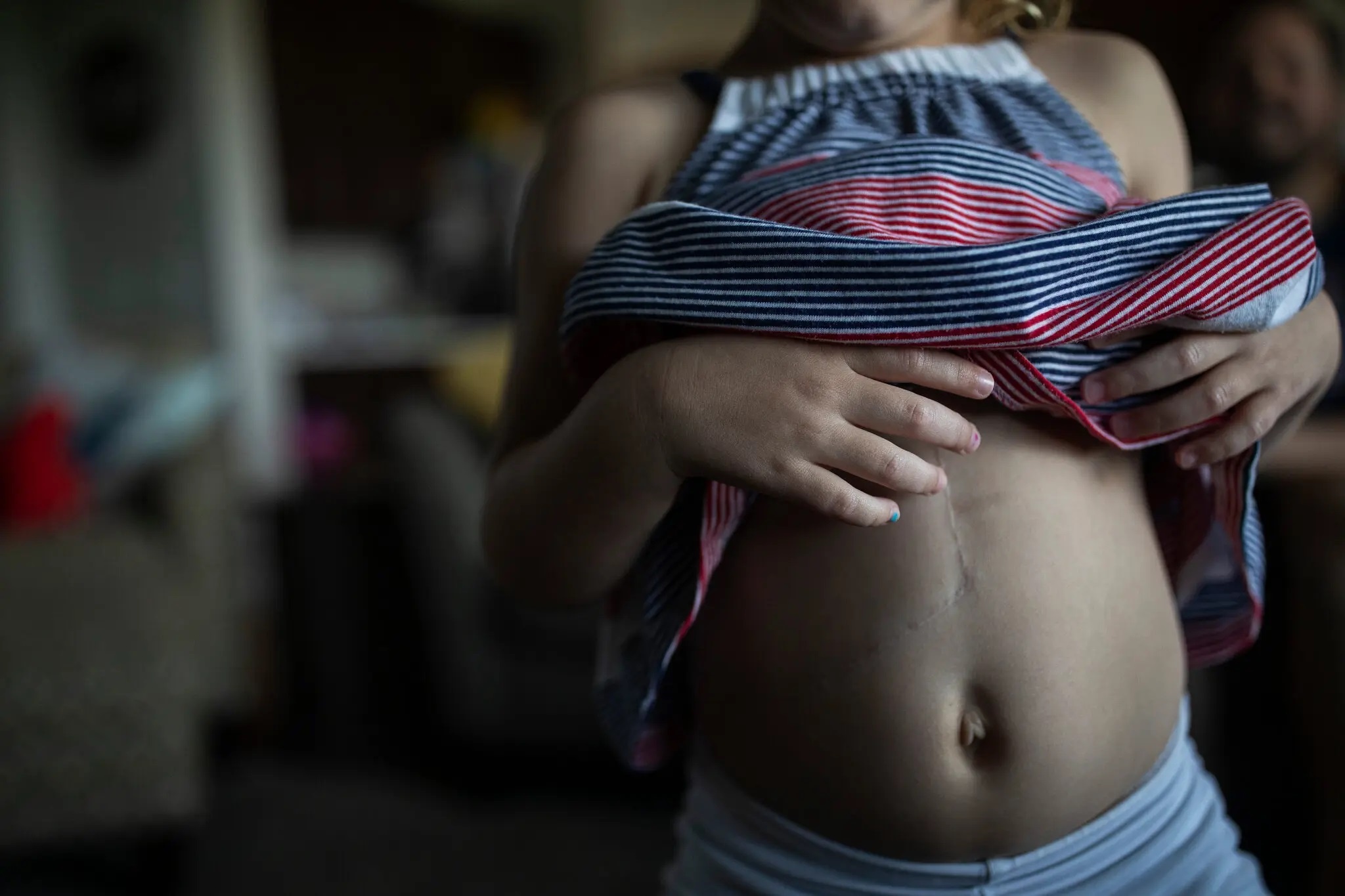 viem gan bi an anh 2