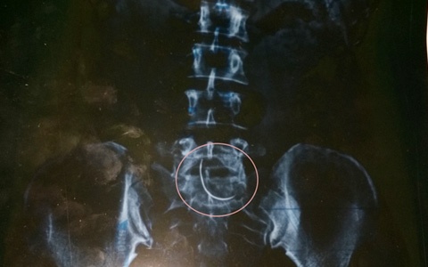 Mo de, bac si ‘quen’ kim trong bung benh nhan 9 nam hinh anh
