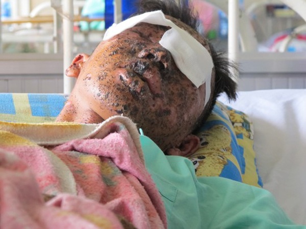 Nau banh tet, thieu nien bi no hu 2 mat hinh anh