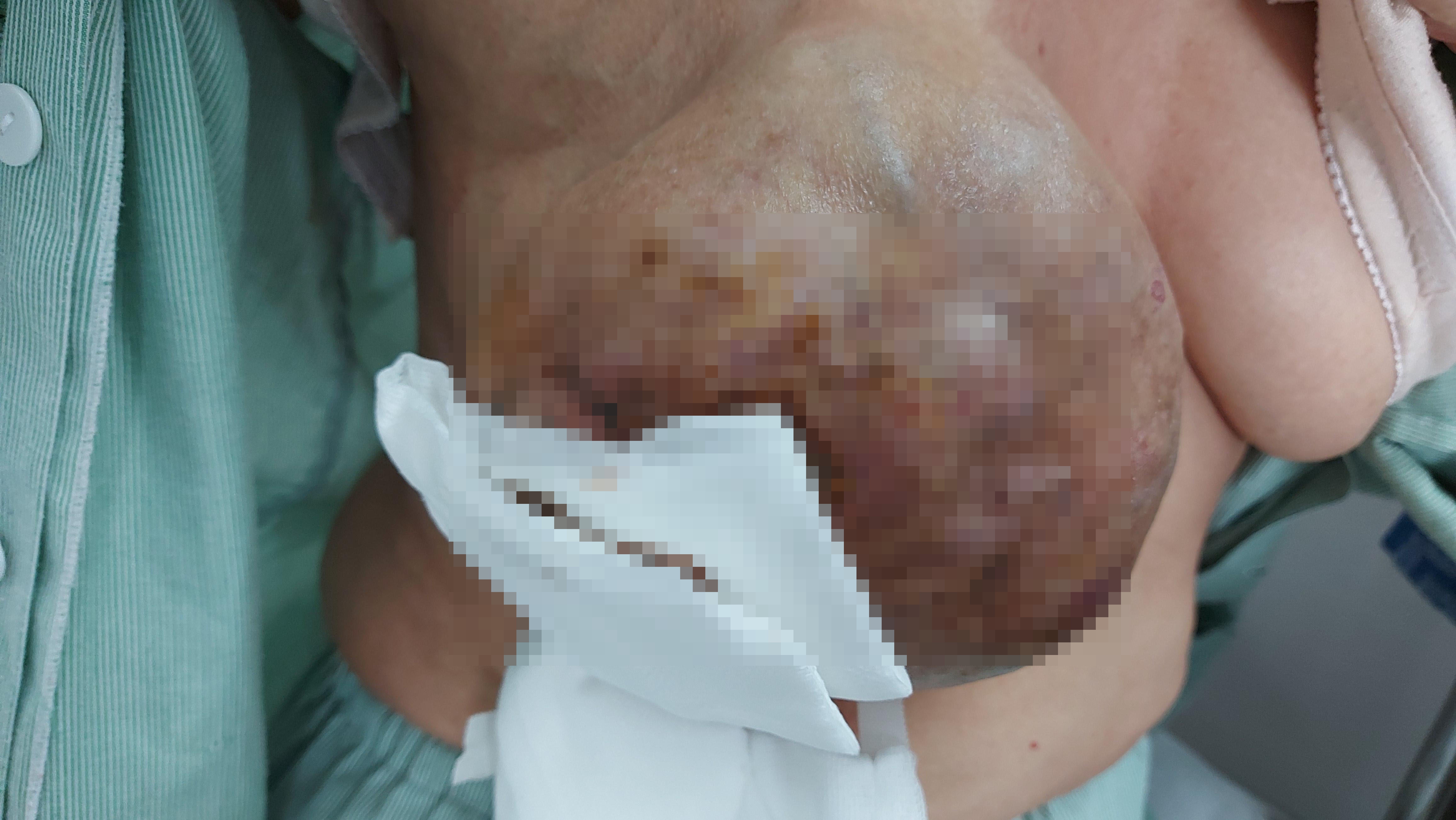 ung thu vu khong lo, anh 1