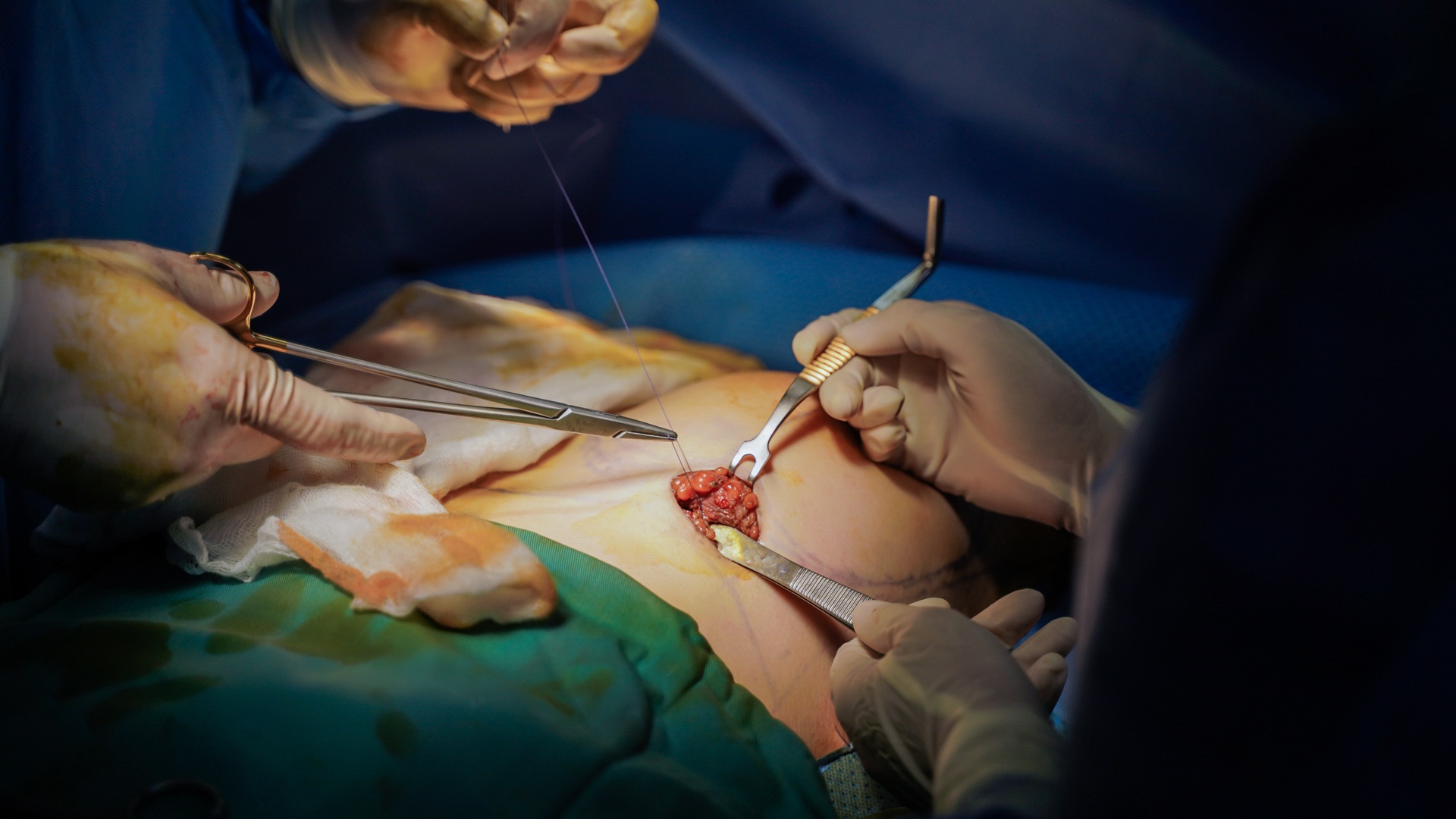 quy trinh nang nguc anh 11