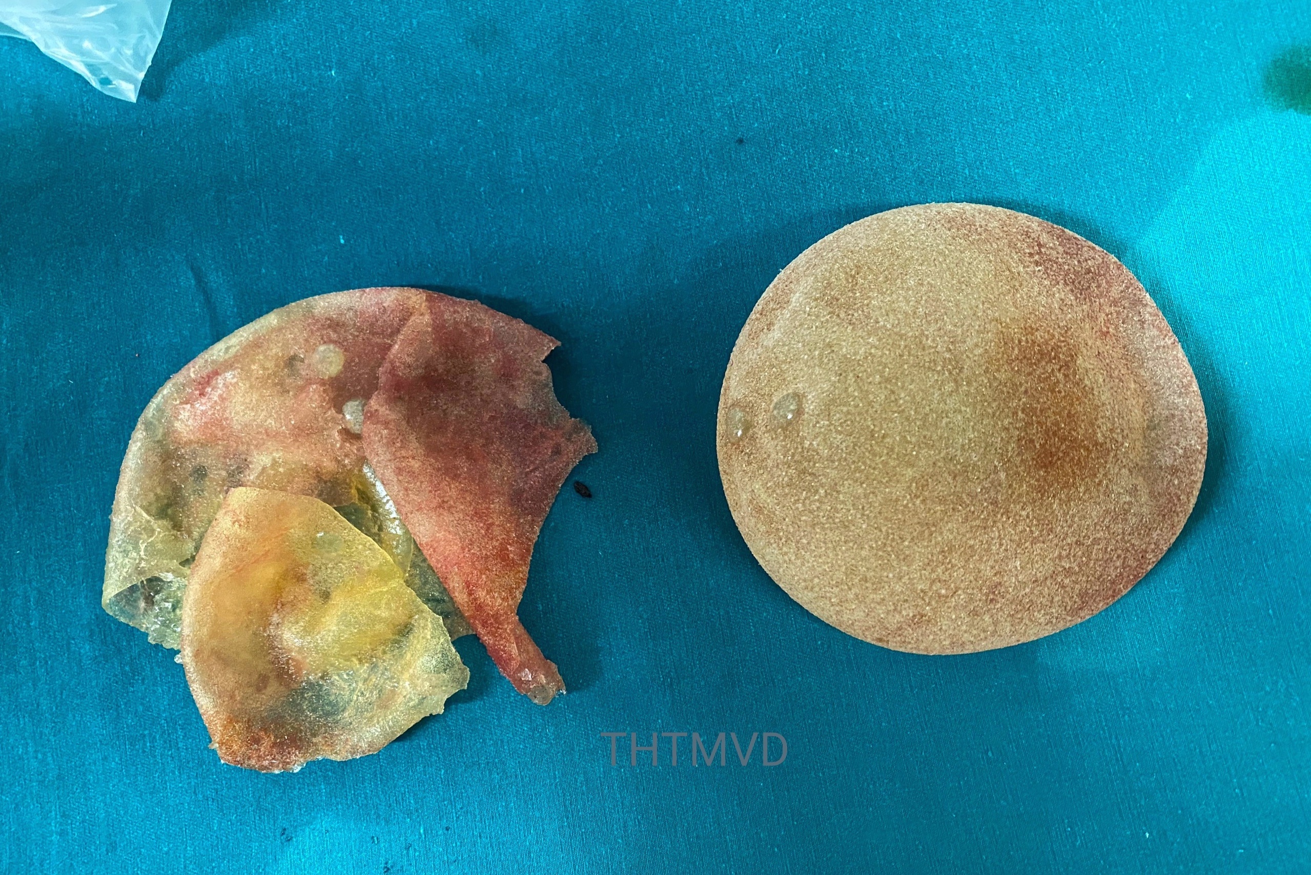 Vo tui nang nguc sau 5 nam nang cap vong mot hinh anh