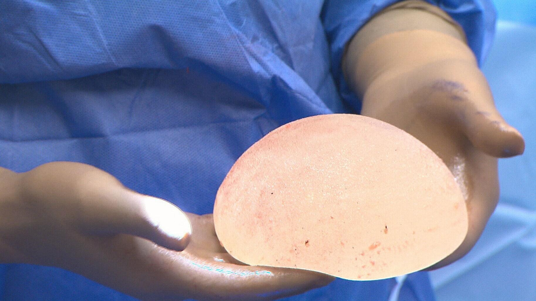 Nguoi phu nu bi vo tui nang nguc sau 6 nam phau thuat hinh anh