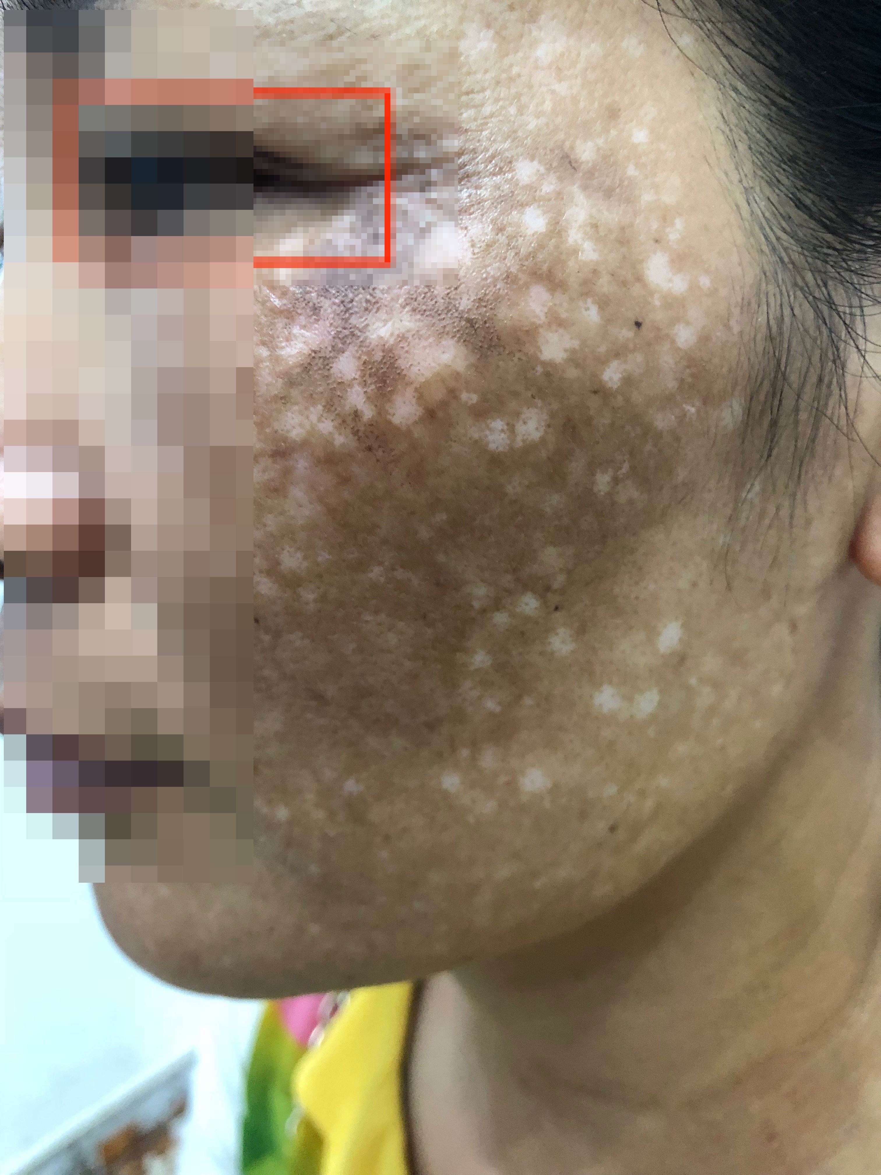 điều trị nám da tại thẩm mỹ viện ảnh 1 dieu tri nam da tai tham my vien anh 1