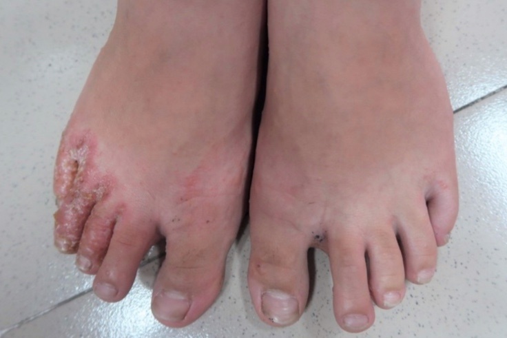 4 benh da lieu nguoi dan tai vung lu can can trong hinh anh