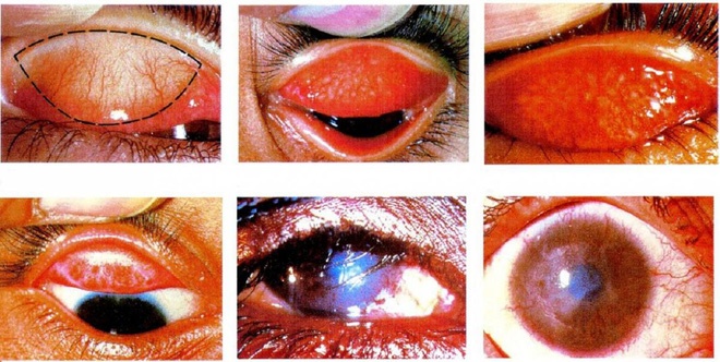 nguy co benh ve mat tai vung lu anh 2