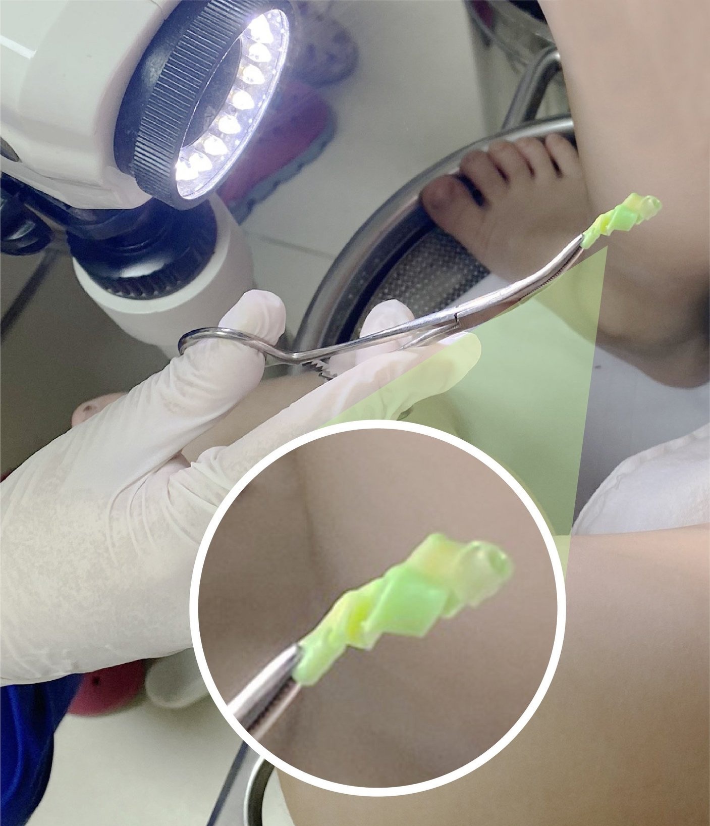 dị vật trong âm đạo trẻ  ảnh 1 di vat trong am dao tre anh 1
