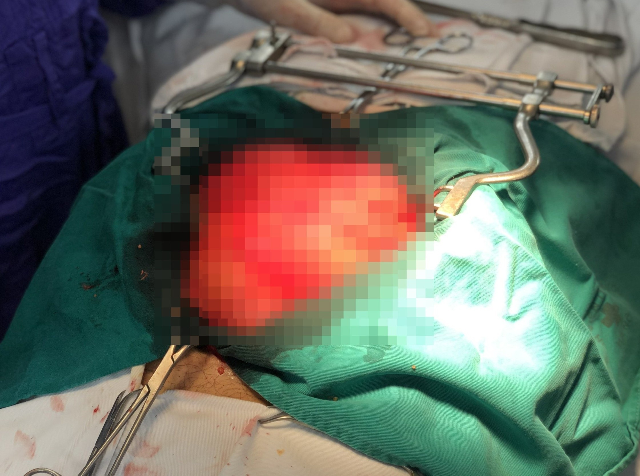 Nguoi dan ong 2 lan tai phat khoi u khong lo hinh anh