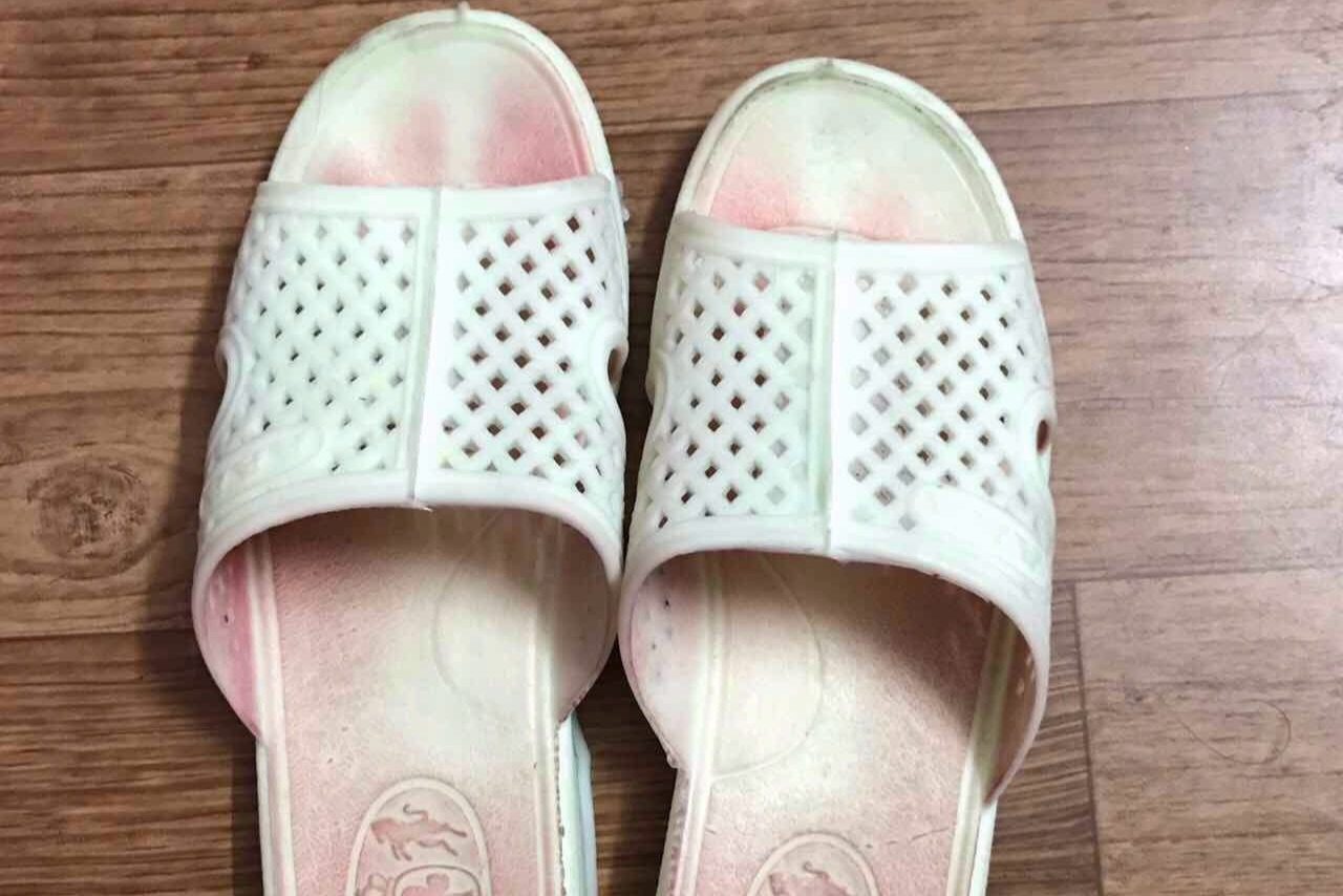 Benh nhan dau tien o Viet Nam xuat hien 'mo hoi mau' hinh anh