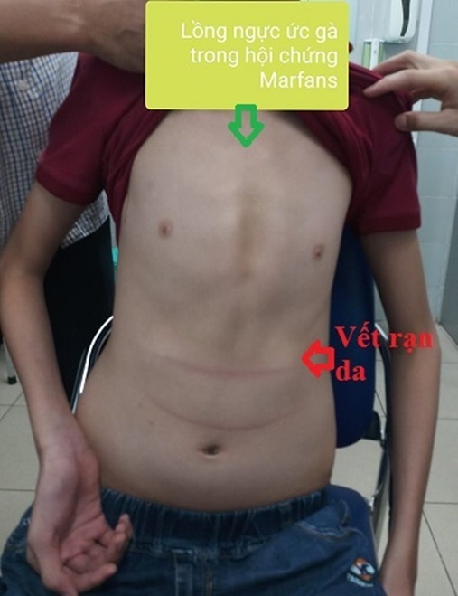 tre cao bat thuong anh 1