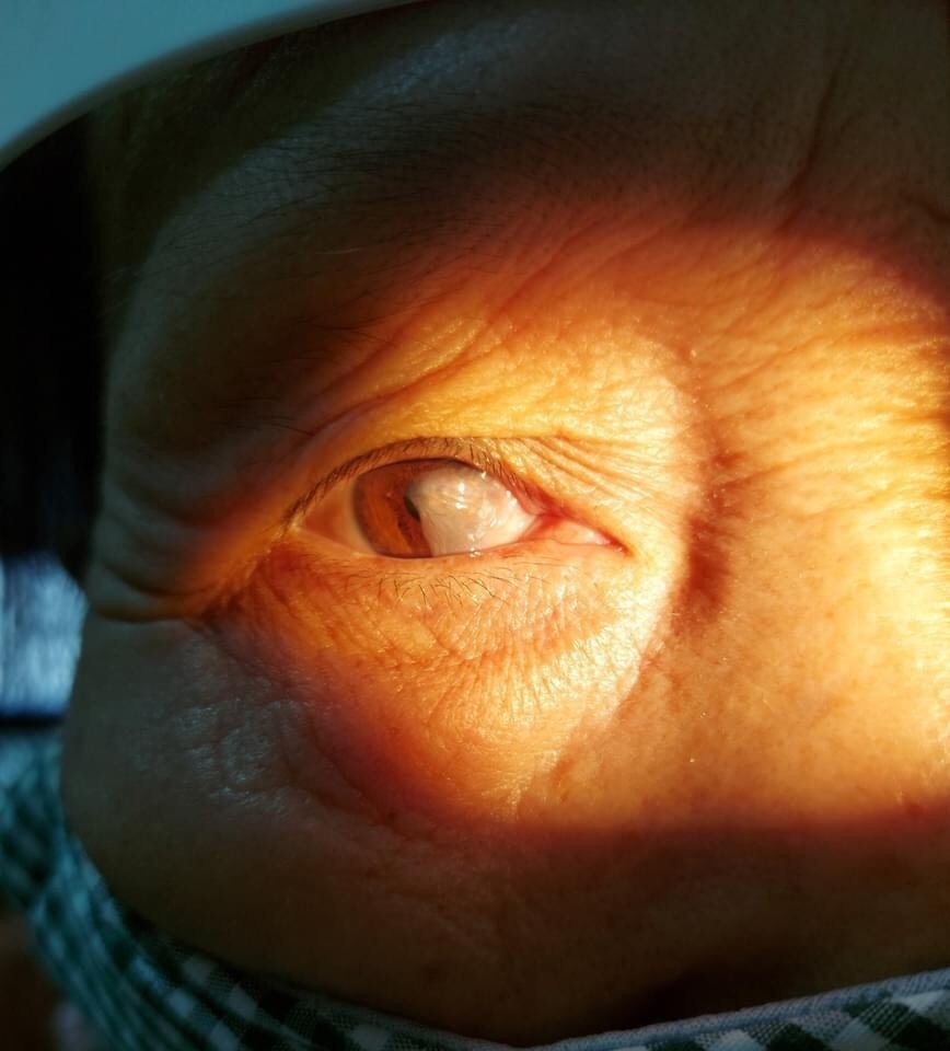 dieu tri mong mat anh 1