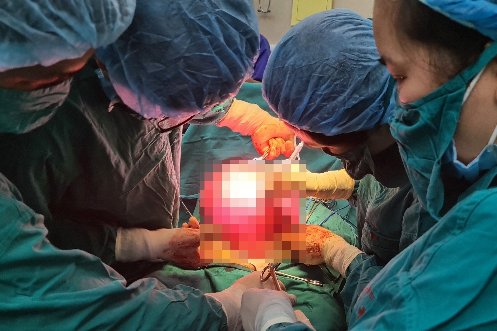 Nguoi phu nu co khoi u nang gan 7 kg hinh anh