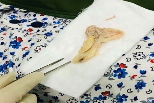 Nguoi phu nu suyt tu vong do sac thit vit hinh anh